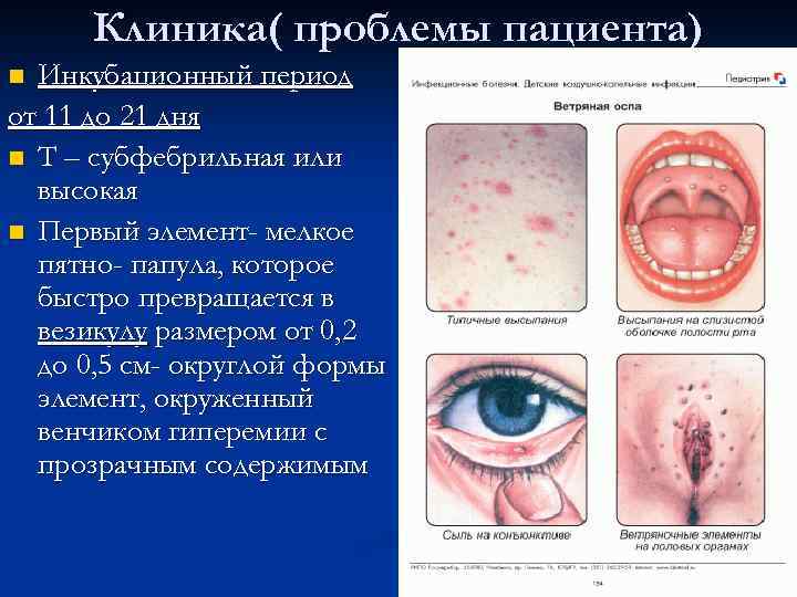 Клиника( проблемы пациента) Инкубационный период от 11 до 21 дня n T – субфебрильная