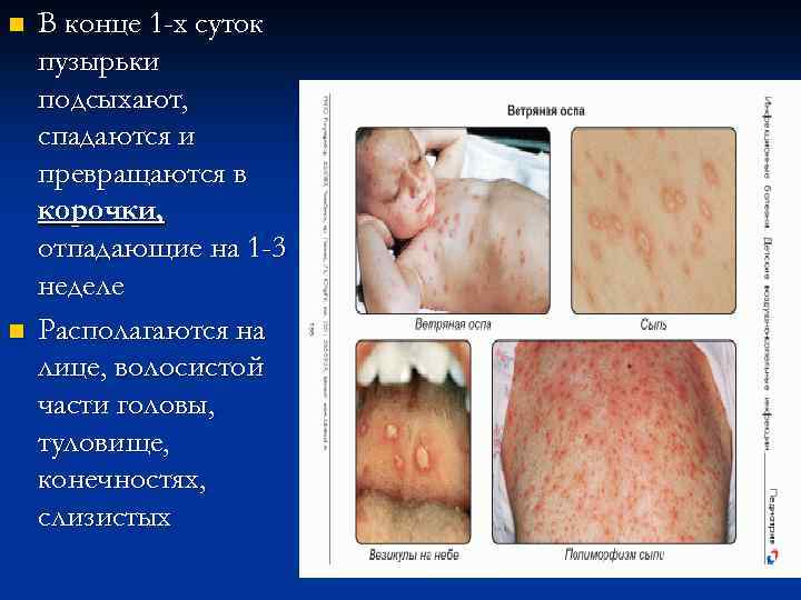 n n В конце 1 -х суток пузырьки подсыхают, спадаются и превращаются в корочки,