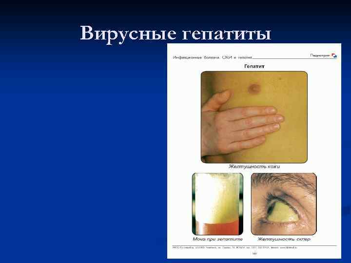 Вирусные гепатиты 