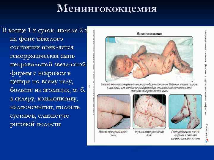 Менингококцемия В конце 1 -х суток- начале 2 -х на фоне тяжелого состояния появляется