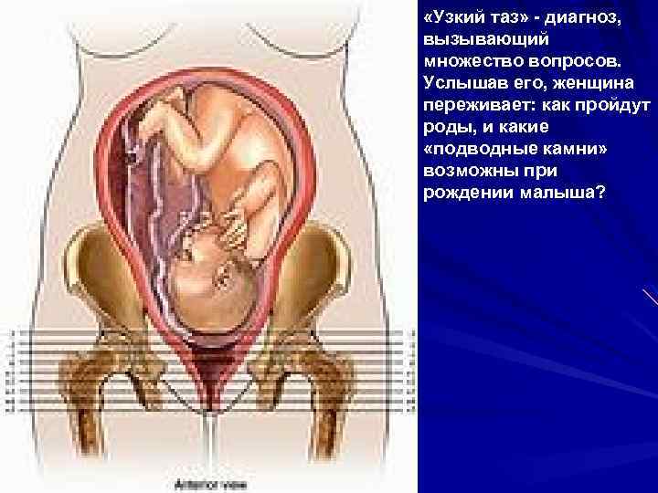 «Узкий таз» - диагноз, вызывающий множество вопросов. Услышав его, женщина переживает: как пройдут