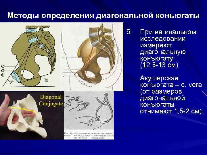 Методы определения диагональной коньюгаты 5. При вагинальном исследовании измеряют диагональную конъюгату (12, 5 -13