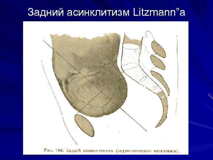 Задний асинклитизм Litzmann”a 