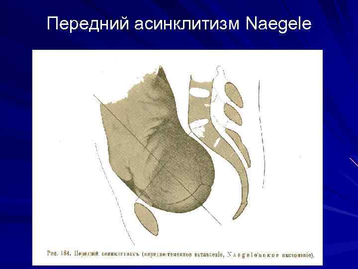 Передний асинклитизм Naegele 