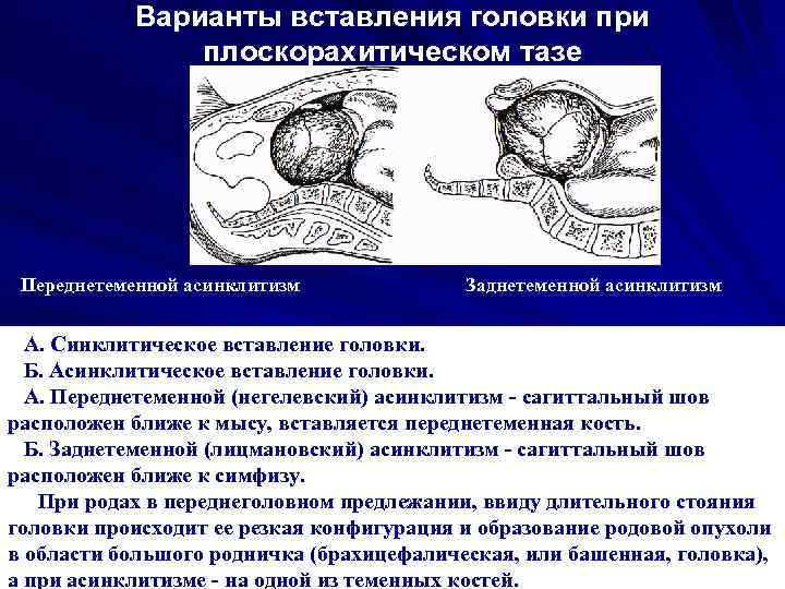 Варианты вставления головки при плоскорахитическом тазе Переднетеменной асинклитизм Заднетеменной асинклитизм А. Синклитическое вставление головки.
