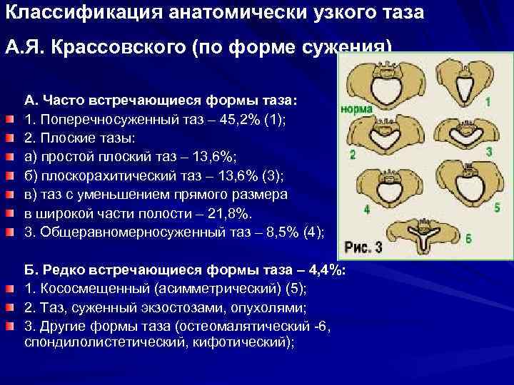 Классификация анатомически узкого таза А. Я. Крассовского (по форме сужения) А. Часто встречающиеся формы