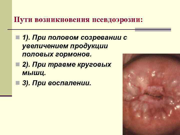 Пути возникновения псевдоэрозии: n 1). При половом созревании с увеличением продукции половых гормонов. n