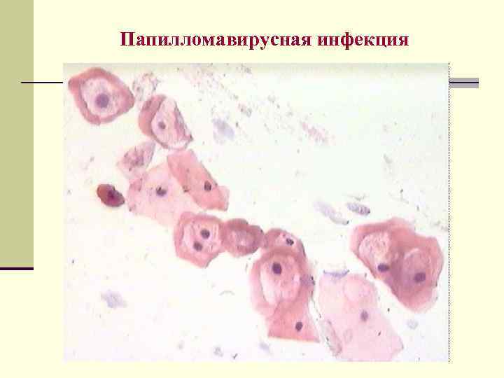 Папилломавирусная инфекция 