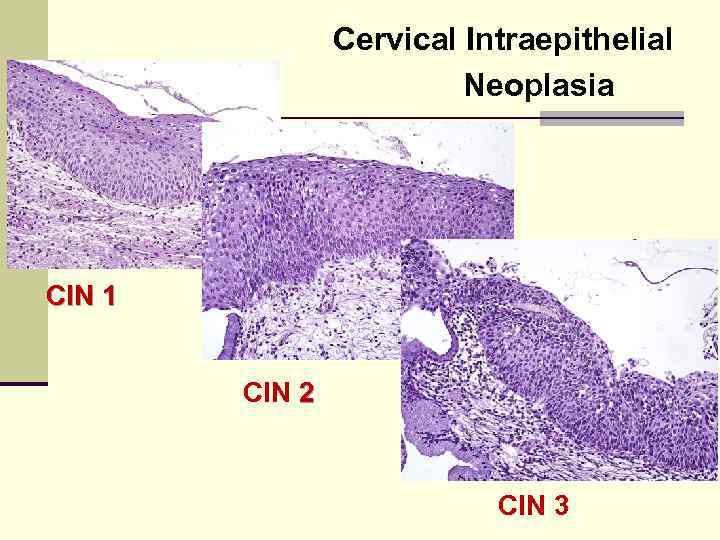 Cervical Intraepithelial Neoplasia CIN 1 CIN 2 CIN 3 
