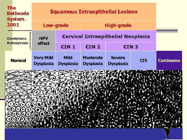 The Bethesda System. 2001 Squamous Intraepithelial Lesions Low-grade Condyloma Koilocytosis HPV effect Normal Very