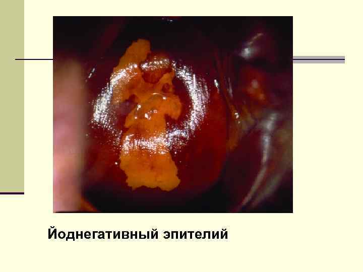 РИСУНОК 2. Йоднегативный эпителий 