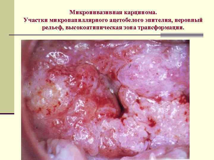 Микроинвазивная карцинома. Участки микропапиллярного ацетобелого эпителия, неровный рельеф, высокоатипическая зона трансформации. 