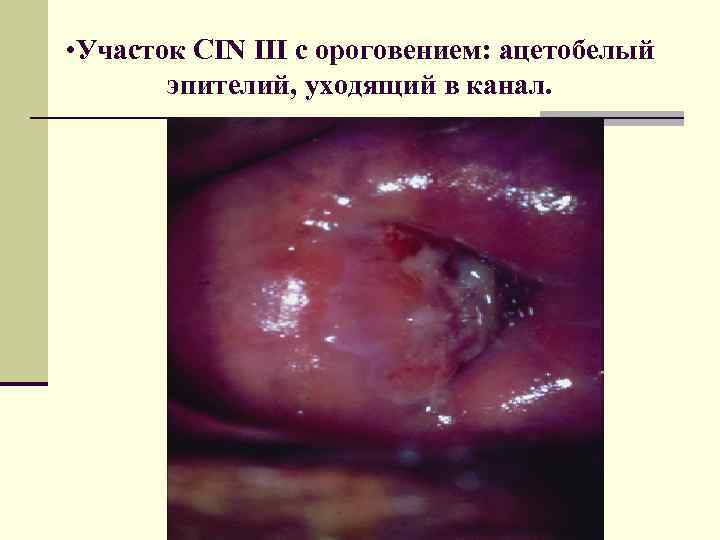  • Участок CIN III c ороговением: ацетобелый эпителий, уходящий в канал. 