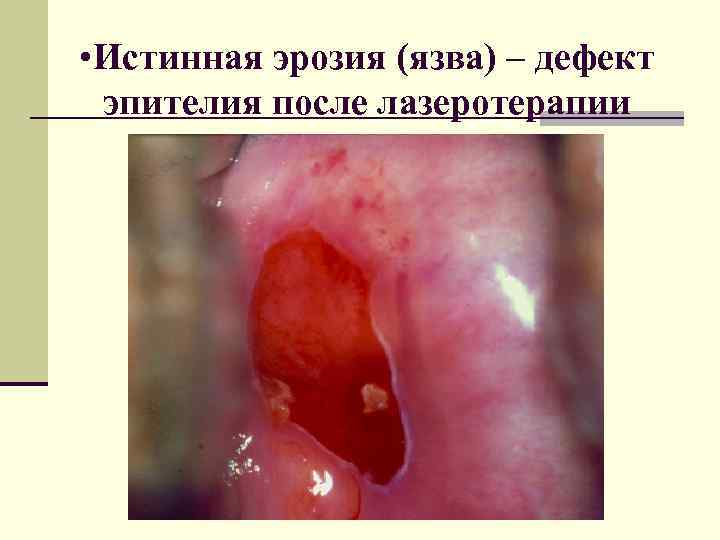  • Истинная эрозия (язва) – дефект эпителия после лазеротерапии 