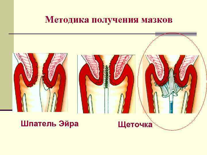 Методика получения мазков Шпатель Эйра Щеточка 
