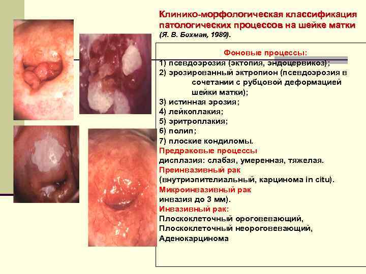 Клинико-морфологическая классификация патологических процессов на шейке матки (Я. В. Бохман, 1989). Фоновые процессы: 1)