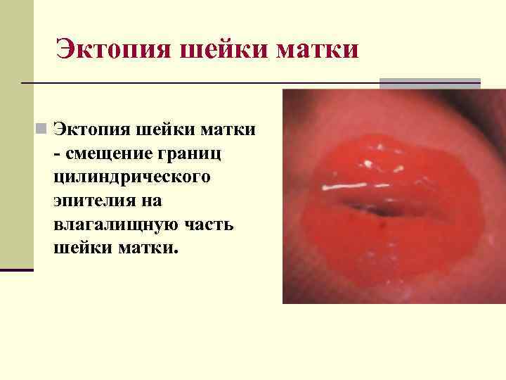 Эктопия шейки матки n Эктопия шейки матки - смещение границ цилиндрического эпителия на влагалищную