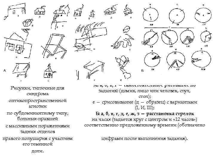 Рисунки, типичные для синдрома оптикопространственной агнозии по субдоминантному типу, больных-правшей с массивными поражениями задних