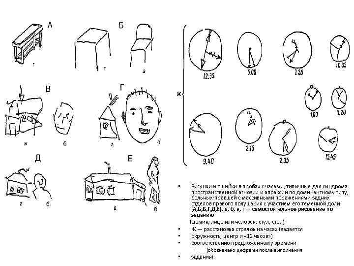 Рисунки и ошибки в пробах с часами, типичные для синдрома пространственной агнозии и апраксии