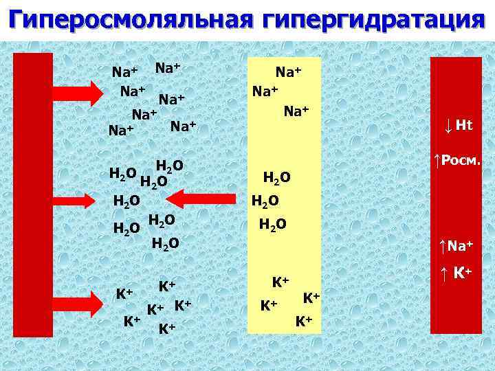 Гиперосмоляльная гипергидратация + Na Na+ Na+ Na+ Н 2 О Н О Н 2