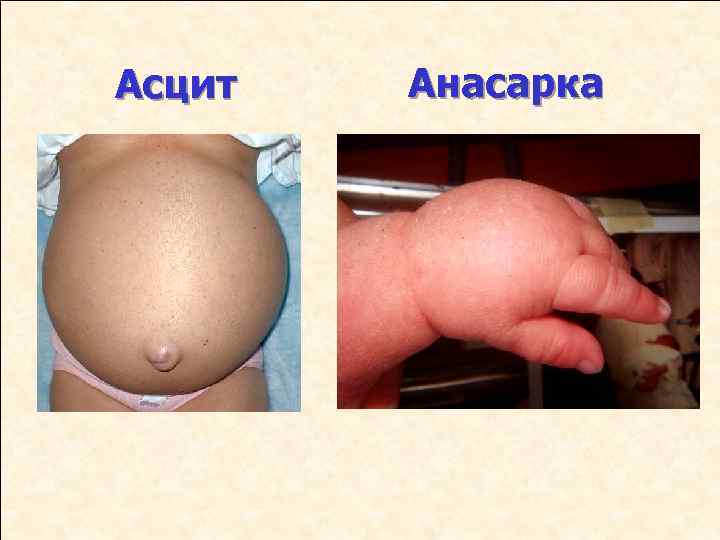 Асцит Анасарка 