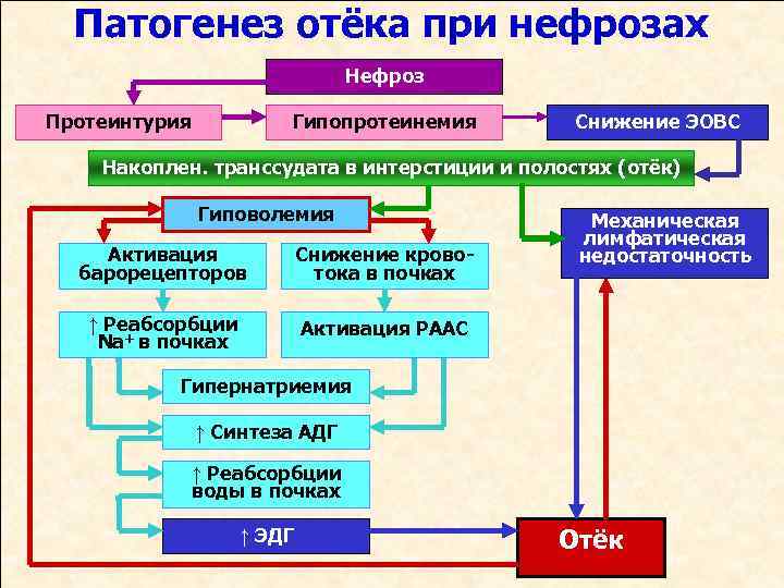 Патогенез отёка при нефрозах Нефроз Протеинтурия Гипопротеинемия Снижение ЭОВС Накоплен. транссудата в интерстиции и