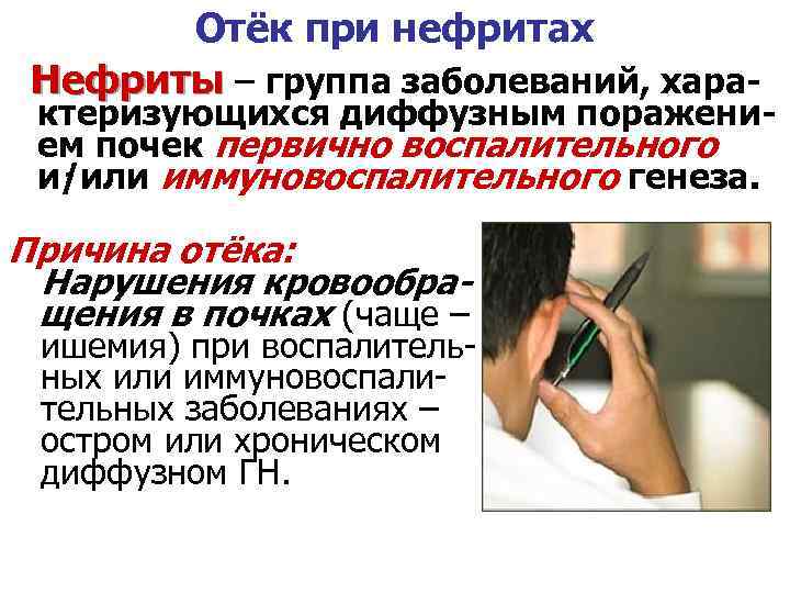 Отёк при нефритах Нефриты – группа заболеваний, хара- ктеризующихся диффузным поражением почек первично воспалительного