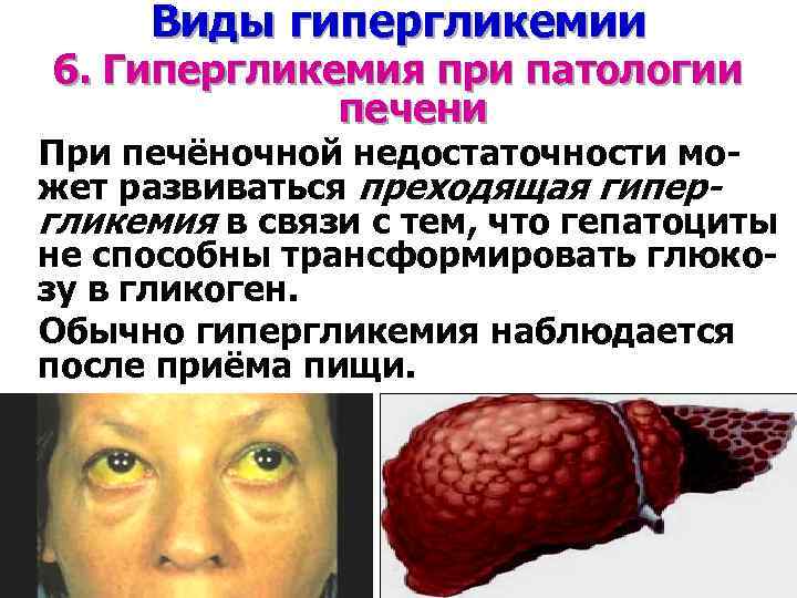 Виды гипергликемии 6. Гипергликемия при патологии печени При печёночной недостаточности может развиваться преходящая гипергликемия