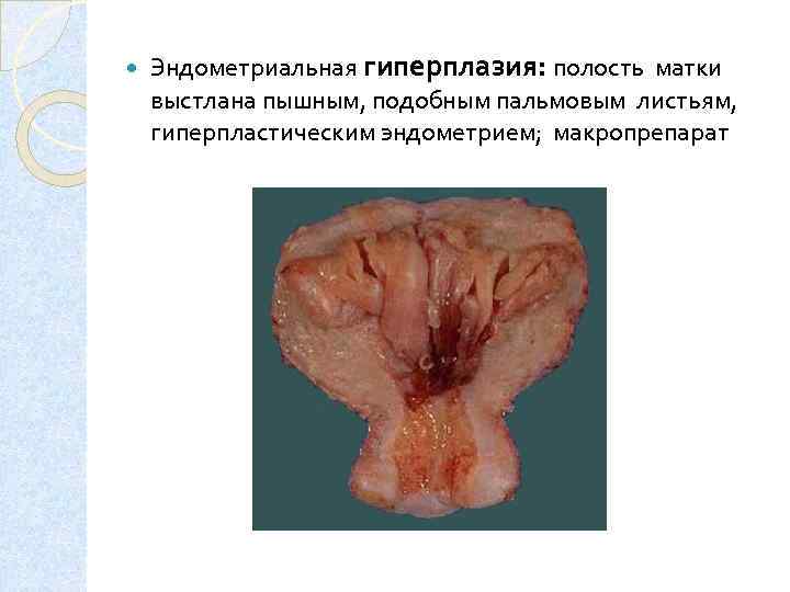  Эндометриальная гиперплазия: полость матки выстлана пышным, подобным пальмовым листьям, гиперпластическим эндометрием; макропрепарат 