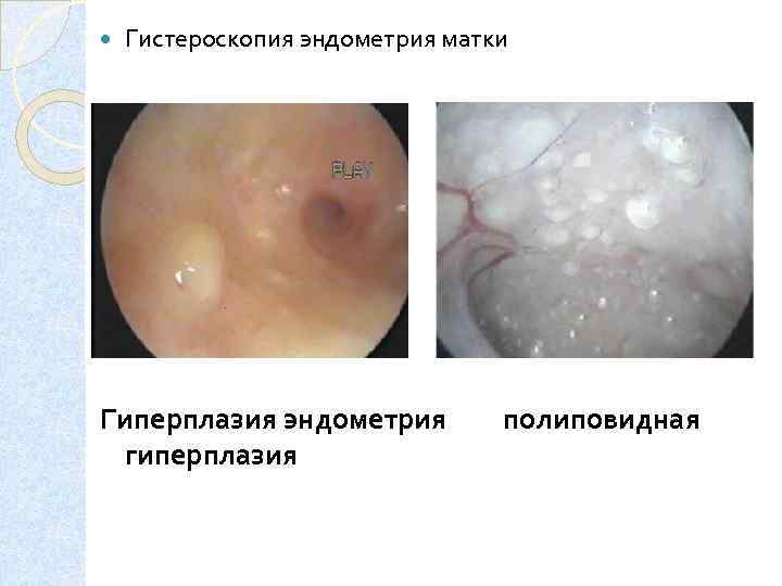  Гистероскопия эндометрия матки Гиперплазия эндометрия гиперплазия полиповидная 
