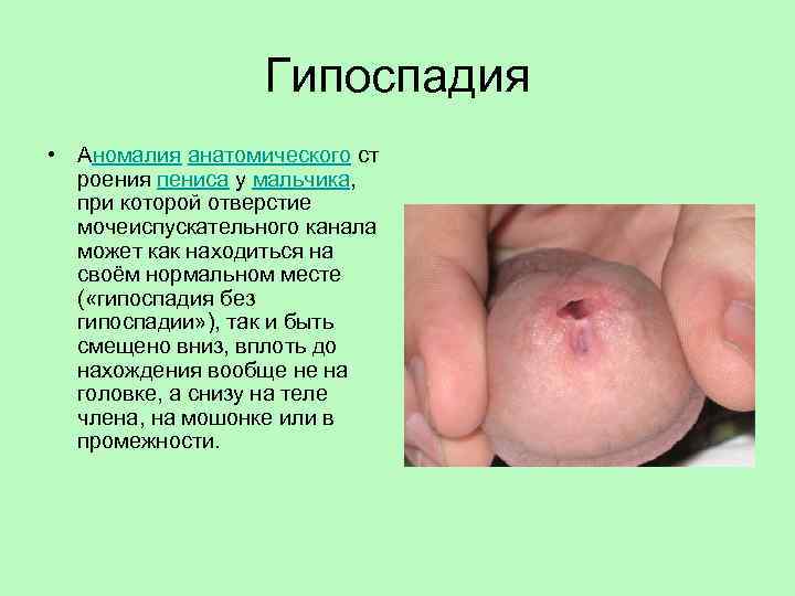 Гипоспадия • Аномалия анатомического ст роения пениса у мальчика, при которой отверстие мочеиспускательного канала