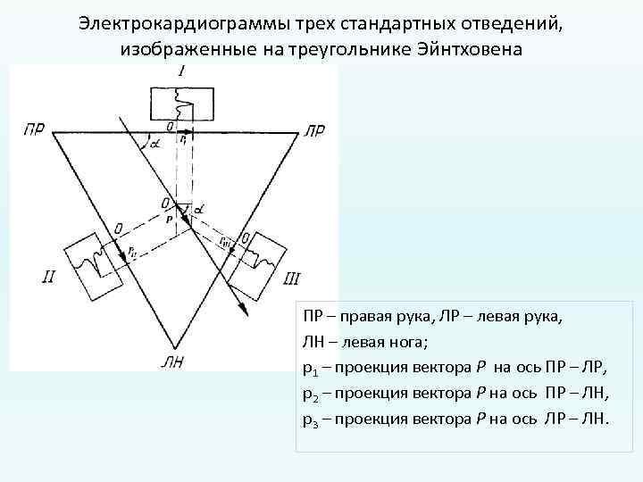 Электрокардиограммы трех стандартных отведений, изображенные на треугольнике Эйнтховена ПР – правая рука, ЛР –