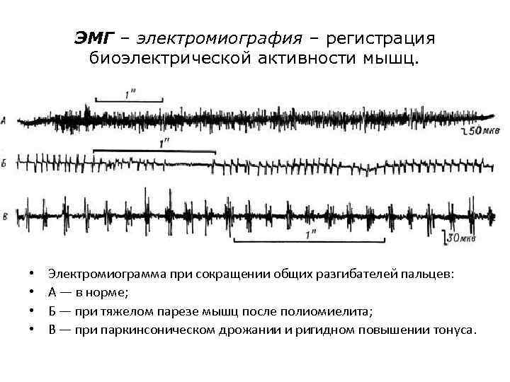 ЭМГ – электромиография – регистрация биоэлектрической активности мышц. • • Электромиограмма при сокращении общих