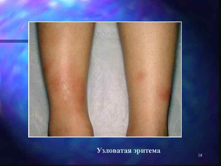 Узловатая эритема 16 