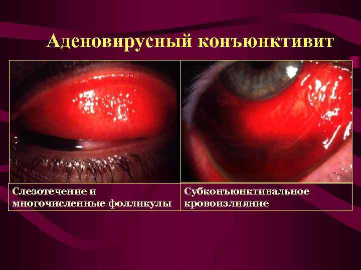 Аденовирусный конъюнктивит Слезотечение и многочисленные фолликулы Субконъюнктивальное кровоизлияние 