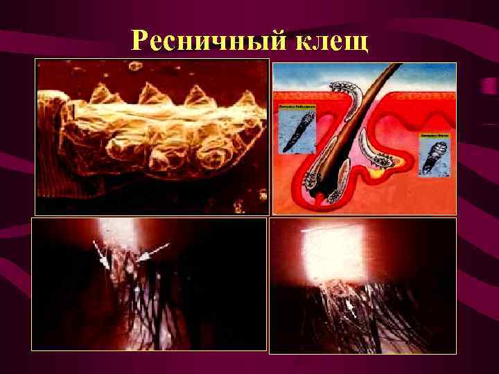 Ресничный клещ 