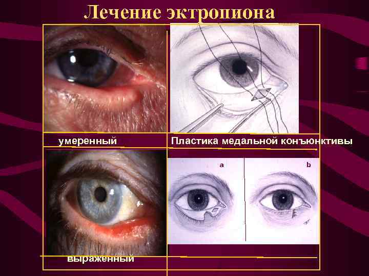 Лечение эктропиона умеренный Пластика медальной конъюнктивы a выраженный b 