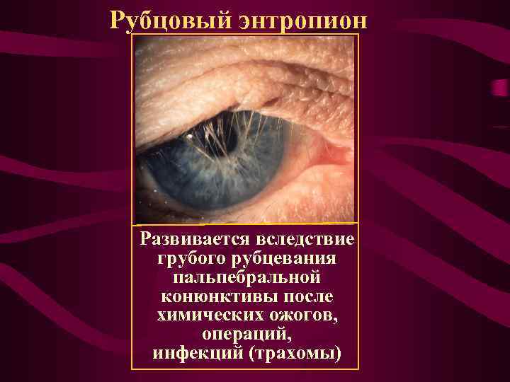 Рубцовый энтропион Развивается вследствие грубого рубцевания пальпебральной конюнктивы после химических ожогов, операций, инфекций (трахомы)