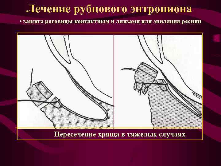 Лечение рубцового энтропиона • защита роговицы контактным и линзами или эпиляция ресниц Пересечение хряща