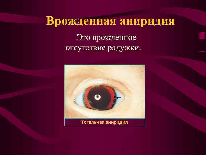 Врожденная аниридия Это врожденное отсутствие радужки. Тотальная аниридия 