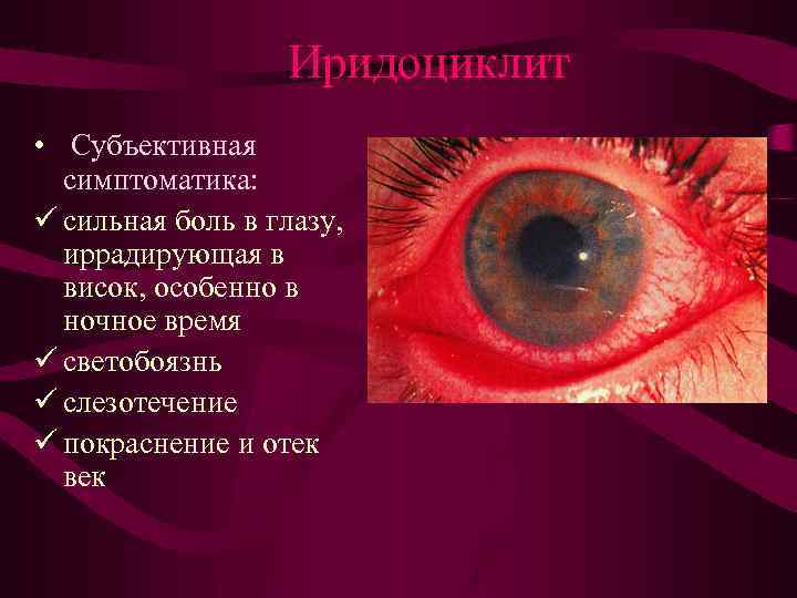 Иридоциклит • Субъективная симптоматика: ü сильная боль в глазу, иррадирующая в висок, особенно в