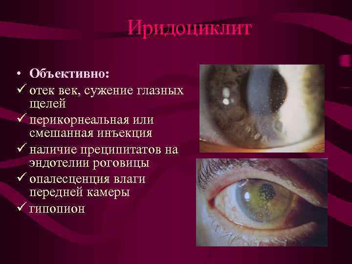 Иридоциклит • Объективно: ü отек век, сужение глазных щелей ü перикорнеальная или смешанная инъекция