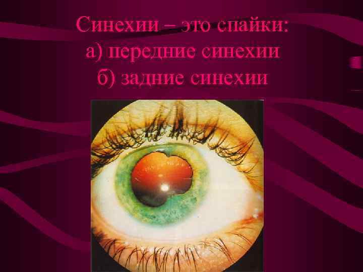 Синехии – это спайки: а) передние синехии б) задние синехии 