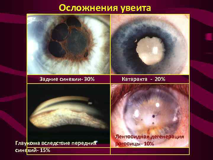 Осложнения увеита Задние синехии- 30% Глаукома вследствие передних синехий- 15% Катаракта - 20% Лентовидная