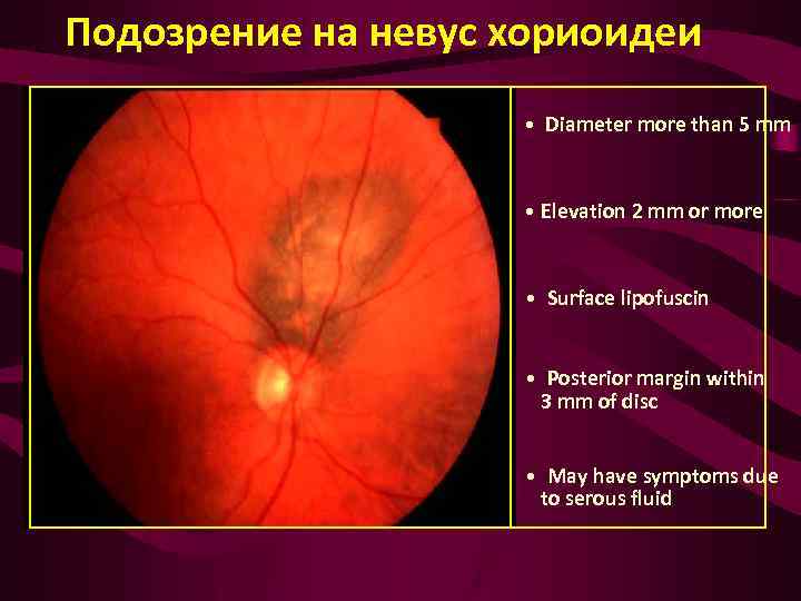 Подозрение на невус хориоидеи • Diameter more than 5 mm • Elevation 2 mm