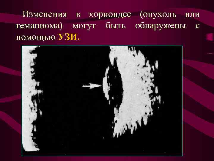 Изменения в хориоидее (опухоль или геманиома) могут быть обнаружены с помощью УЗИ. 