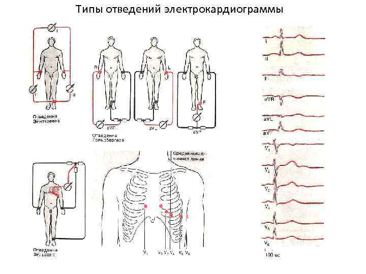 Типы отведений электрокардиограммы 