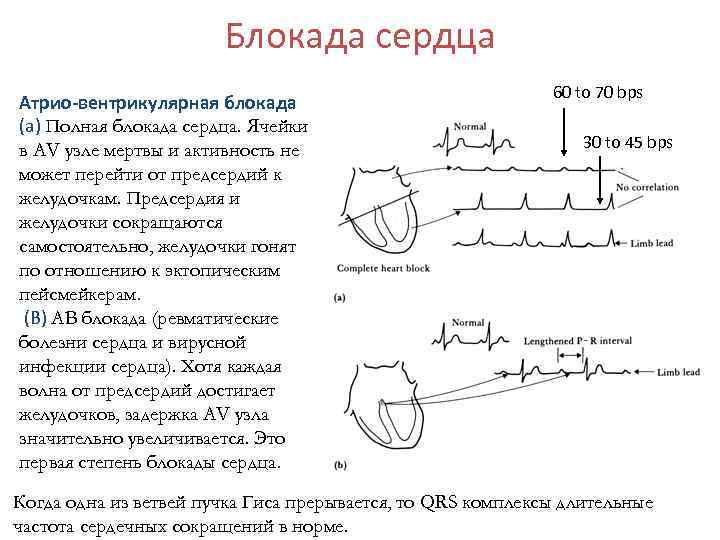 Блокада сердца Атрио-вентрикулярная блокада (a) Полная блокада сердца. Ячейки в AV узле мертвы и