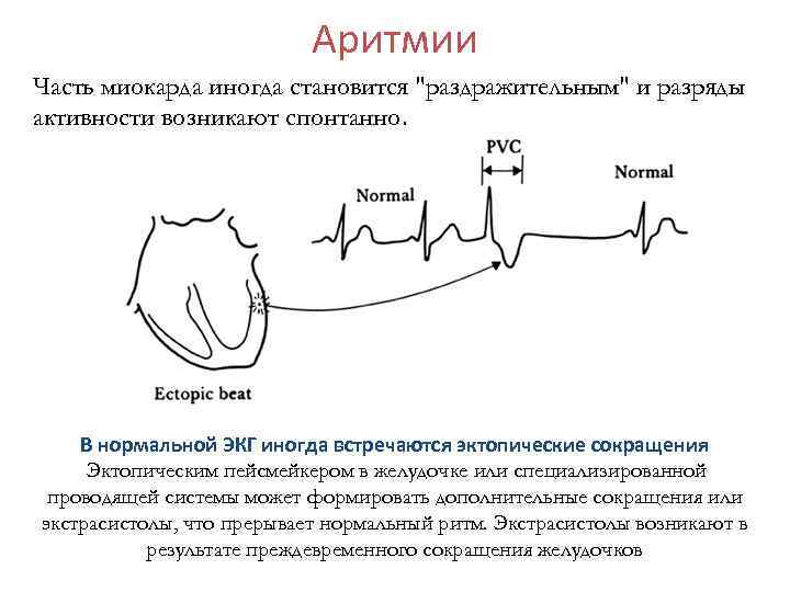 Аритмии Часть миокарда иногда становится "раздражительным" и разряды активности возникают спонтанно. В нормальной ЭКГ