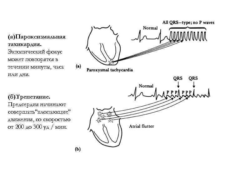 (а)Пароксизмальная тахикардия. Эктопический фокус может повторятся в течении минуты, часа или дня. (б)Трепетание. Предсердия